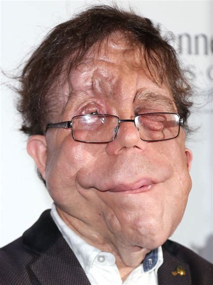 Adam Pearson: The Inspiring Journey of an Actor with Neurofibromatosis