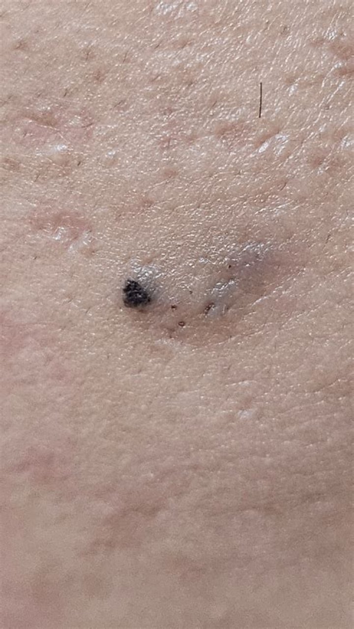 Effective Strategies to Combat Black Spot Pimples: Your Ultimate Guide