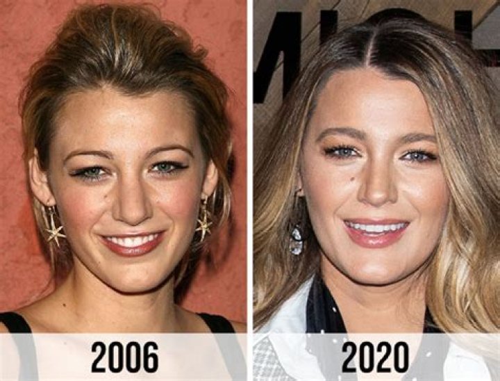 Blake Lively Nose Job: The Truth Behind the Transformation