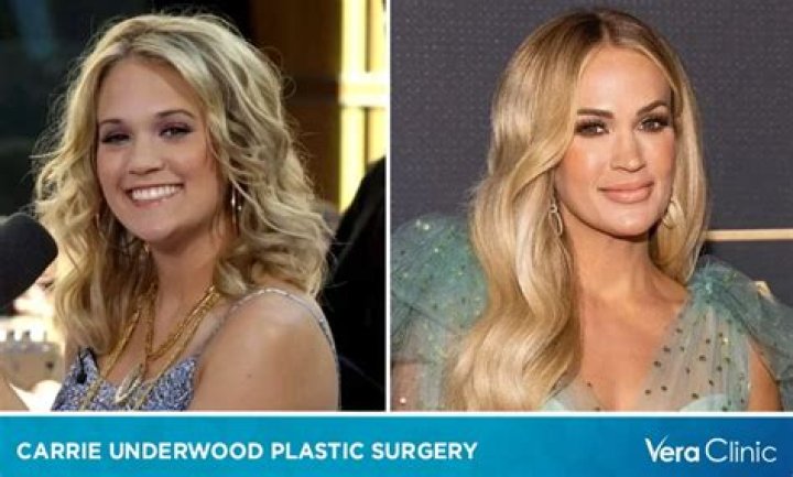 Carrie Underwood Plastic Surgery: The Facts, Myths, and Her Journey to Confidence