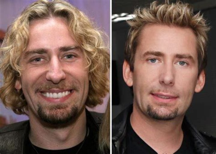 Chad Kroeger Nose Job: The Transformation of a Rock Star