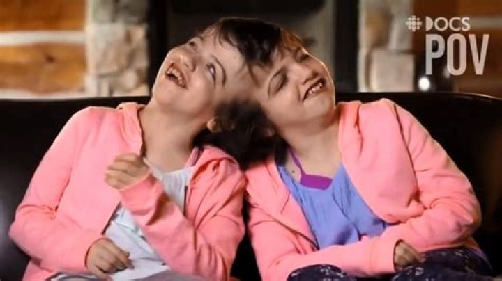 Conjoined Twins Tatiana and Krista: An Inspiring Journey in 2024