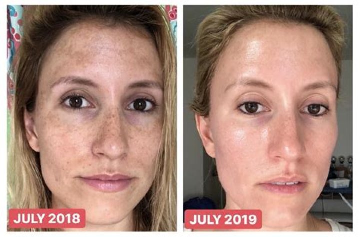 Differin Adapalene Before and After: Transform Your Skin with Expert Guidance