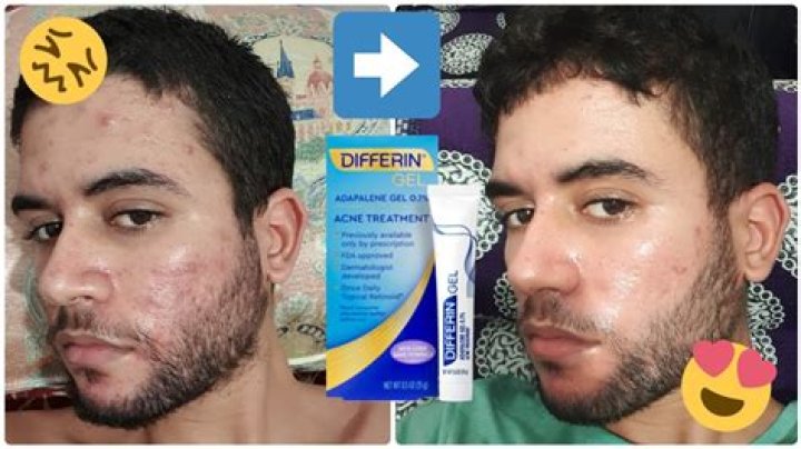 Differin Gel Before and After: Transform Your Skin with This Powerful Acne Treatment