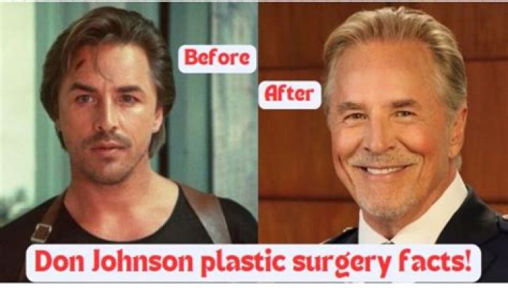 Don Johnson Plastic Surgery: A Comprehensive Look at His Journey and Transformations