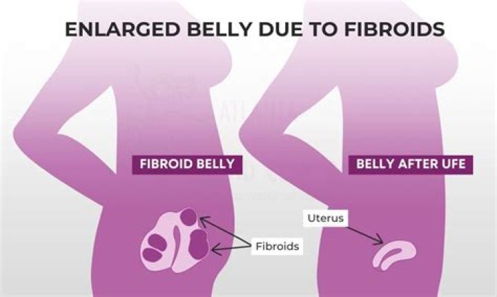 Transformations Unveiled: Fibroid Belly Pictures Before and After