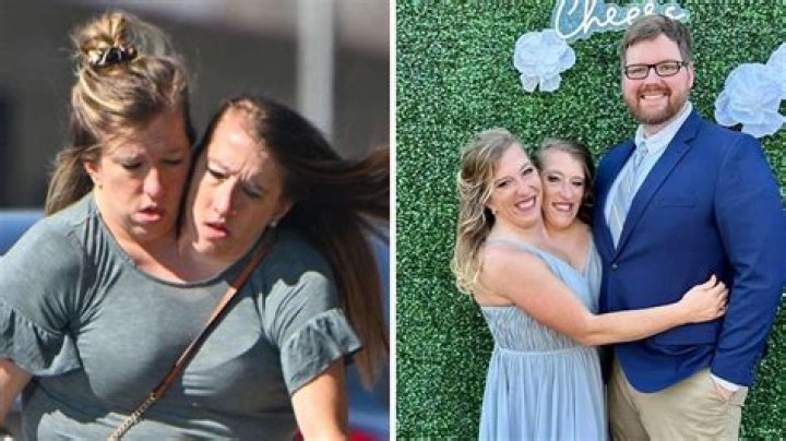 Hensel Twins Sad News: A Deep Dive into Their Journey and Challenges