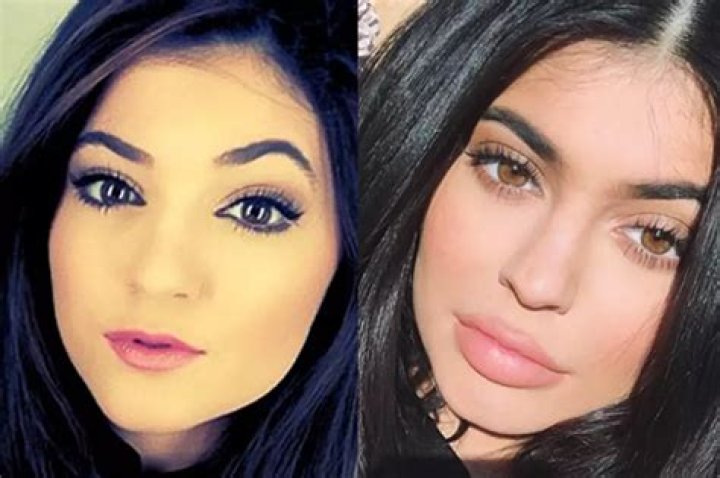Kylie Jenner's Lips: The Secret Behind Her Iconic Look