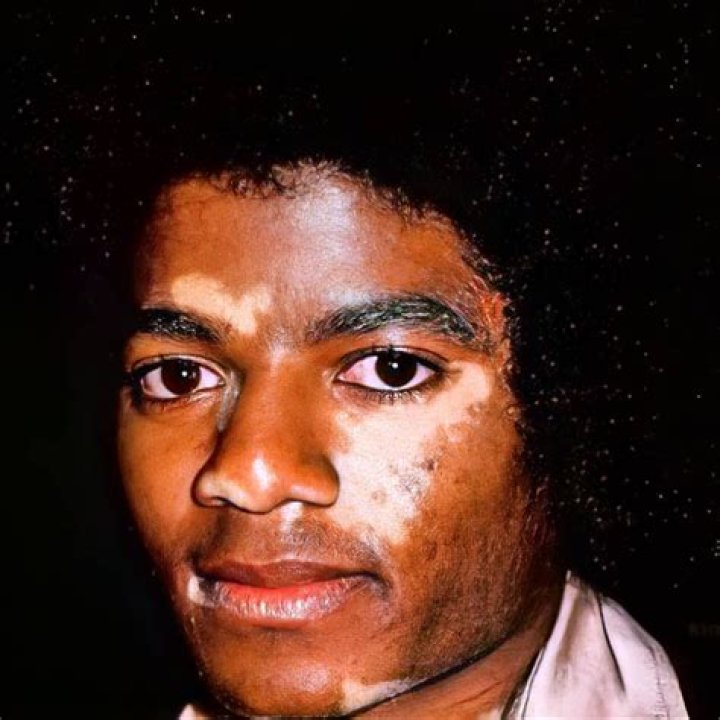 Michael Jackson Skin Disorder: The Truth Behind His Changing Complexion