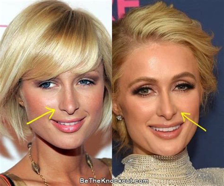 Unveiling the Truth Behind Paris Hilton's Plastic Surgery Journey