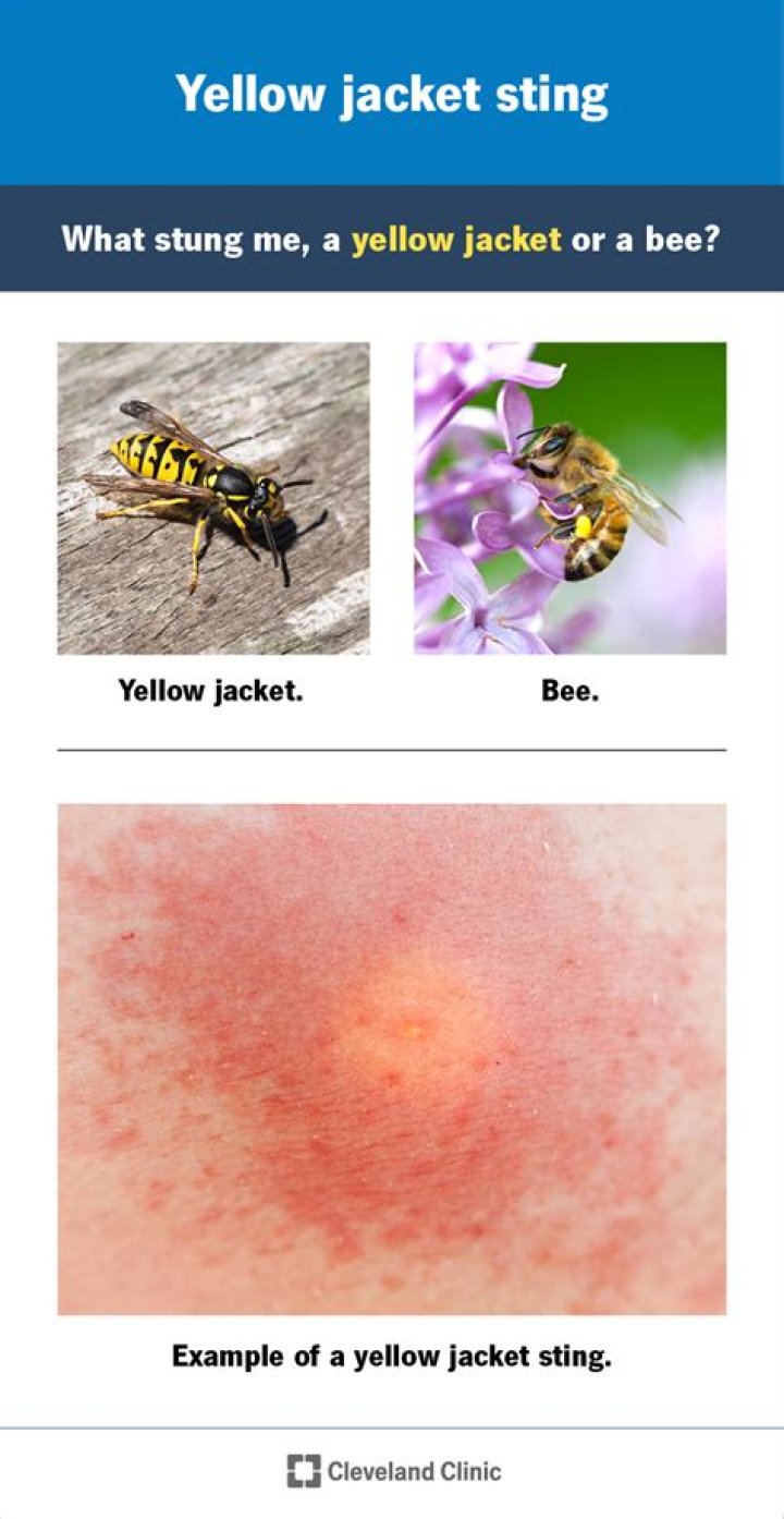 Understanding Pictures of Yellow Jacket Stings: An In-Depth Look