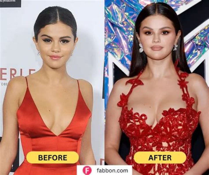 Selena Gomez and Breast Augmentation: A Comprehensive Insight