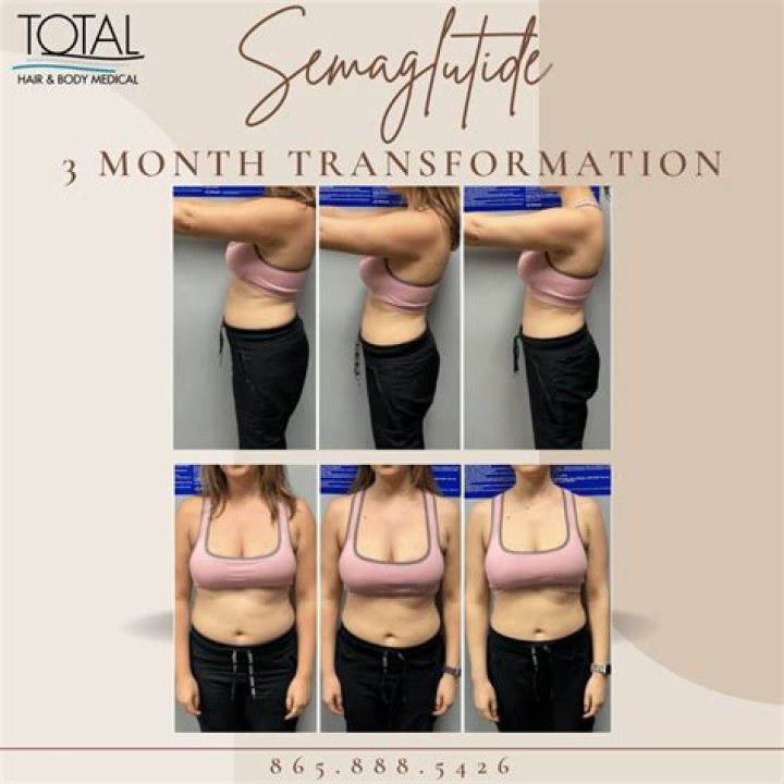 Semaglutide Before and After: A Comprehensive Guide to Weight Loss Success