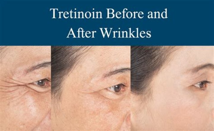 Tretinoin Triumph: The Journey from Wrinkles to Radiance